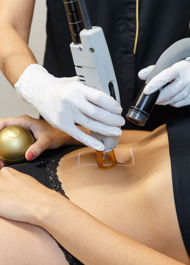 epilation definitive nos lasers Epilia