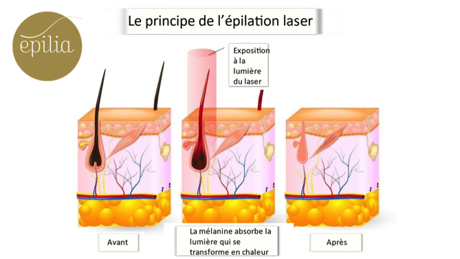 Principe types de laser épilation