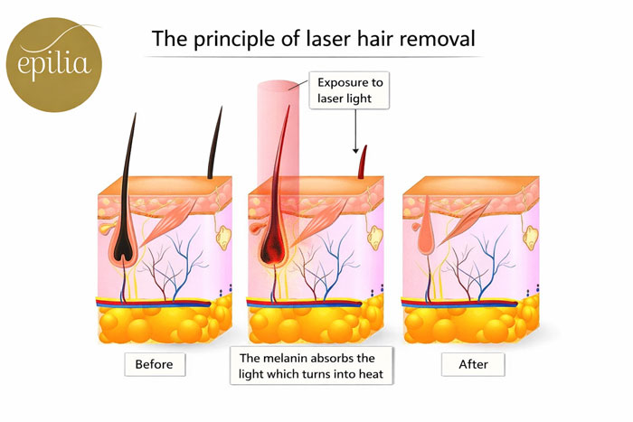 what are the different types of lasers