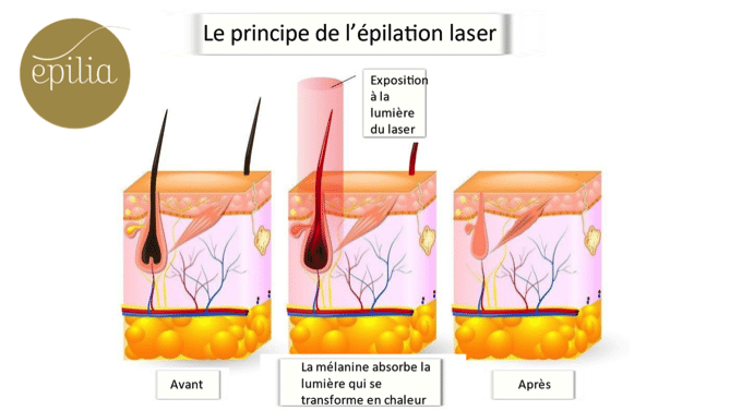 Le principe de l'épilation laser