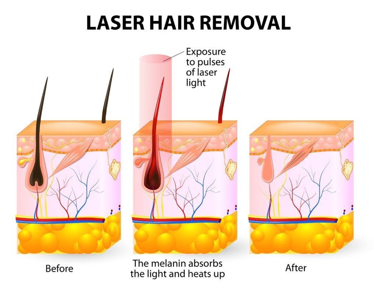 The principle of laser hair removal