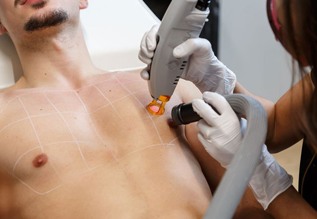 épilation laser pour homme ventre