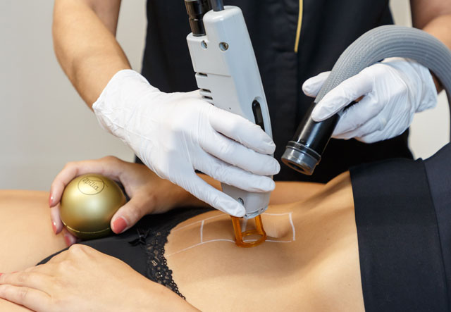 épilation laser technologie