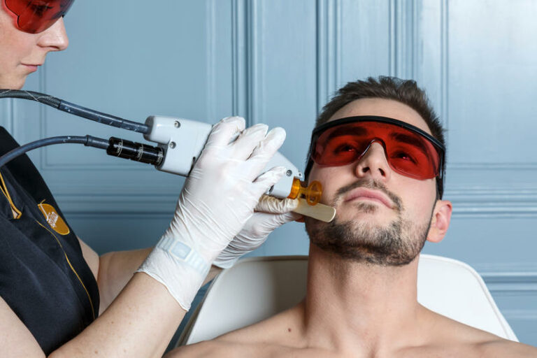 Facial laser hair removal