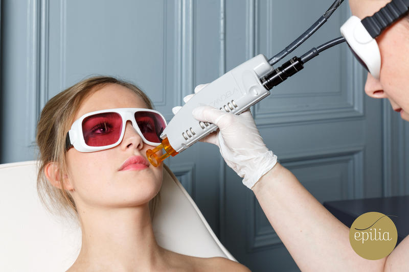 facial-laser-hair-removal