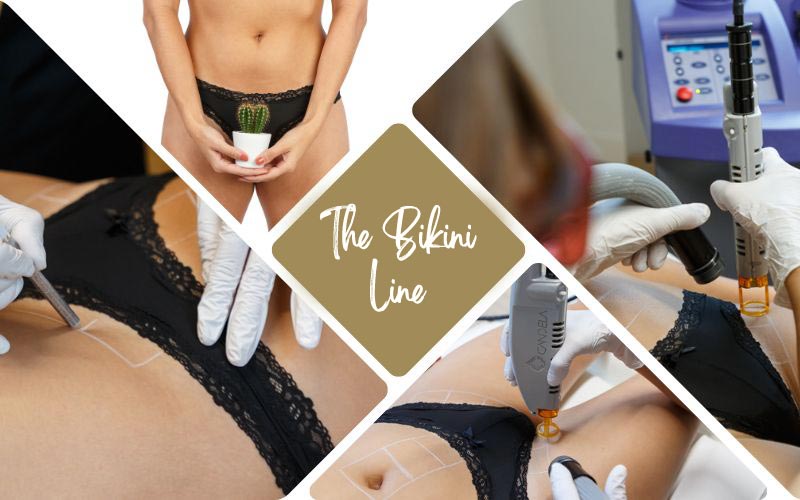 Laser hair removal for the bikini line