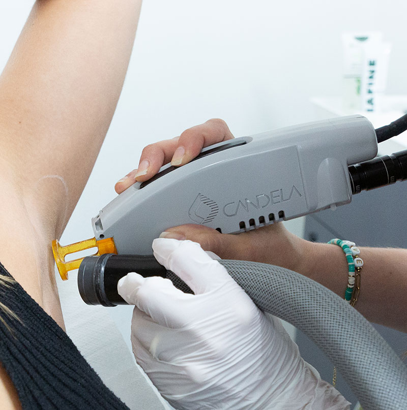 permanent hair removal with laser-epilia