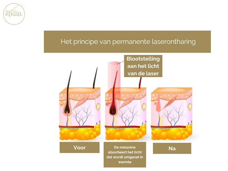 Het principe van laserontharing