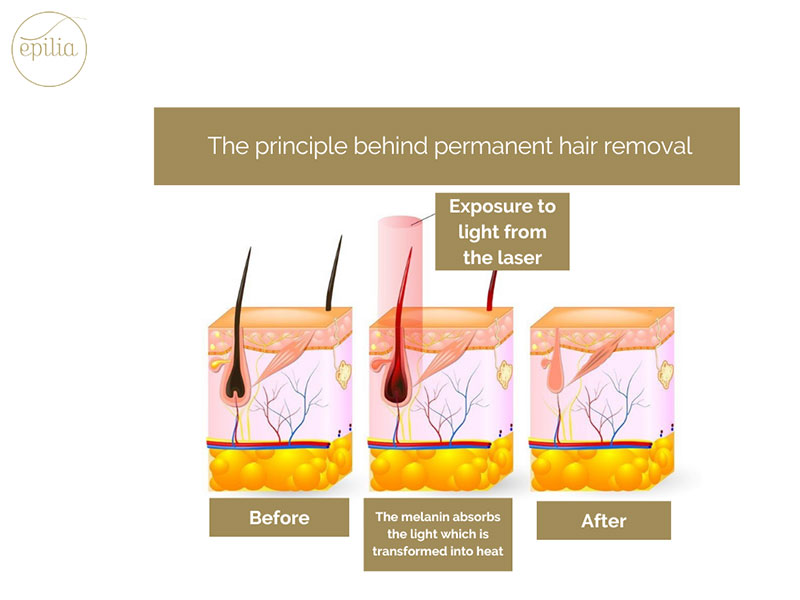 EPILIA-The principle of laser hair removal