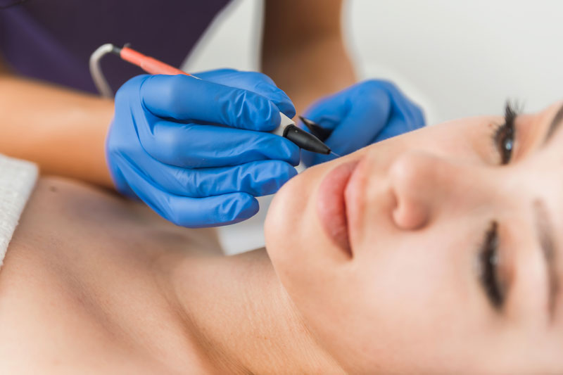 electrolyse epilation visage