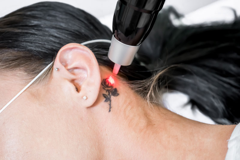 epilation laser tatouage risques protection differerence lasers