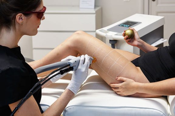 Epilation électrique VS épilation au laser : les différences